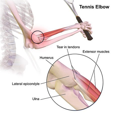 Tennis Elbow Treatment in NYC